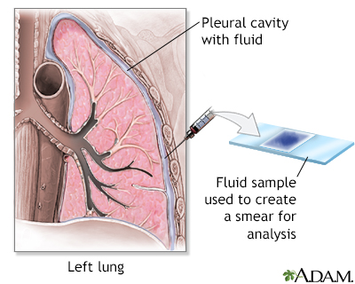 Pleural smear - Illustration Thumbnail
              