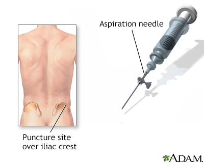 Bone Marrow Biopsy Information Mount Sinai New York