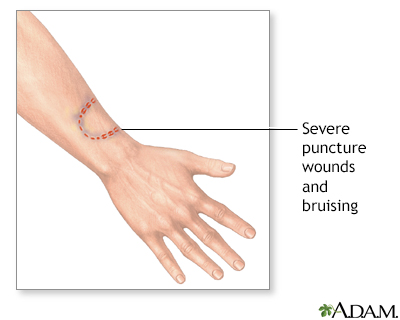 human bite marks on skin