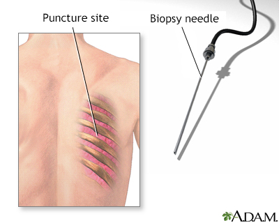 Lung biopsy - Illustration Thumbnail              