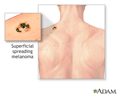 superficial spreading melanoma stages