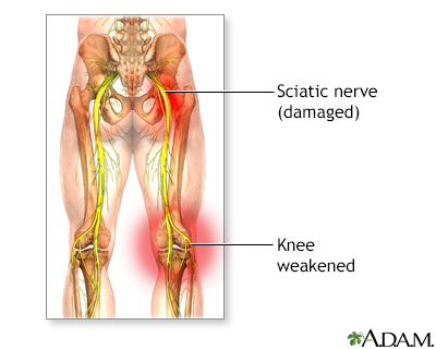 Sciatica Information  Mount Sinai - New York