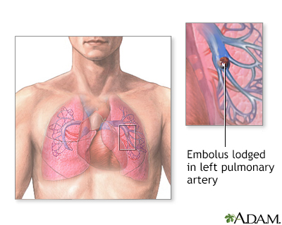 Pulmonary embolus - Illustration Thumbnail
              