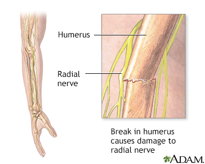 Radial nerve dysfunction