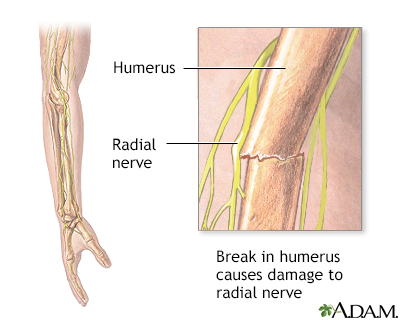 Radial nerve dysfunction - Illustration Thumbnail
                      