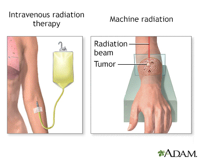 Radiation therapy - Illustration Thumbnail
              