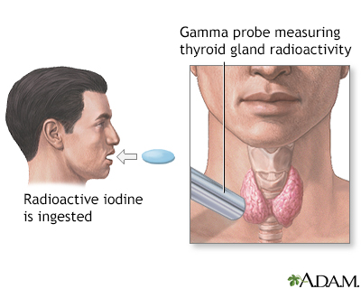 Radioactive iodine on sale