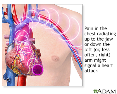 Symptômes de crise cardiaque