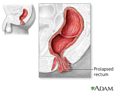 Rectal prolapse Information Mount Sinai New York