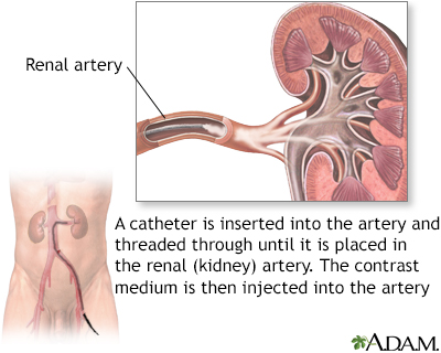 Renal arteries - Illustration Thumbnail
              