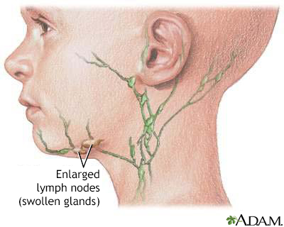 very swollen lymph nodes in neck