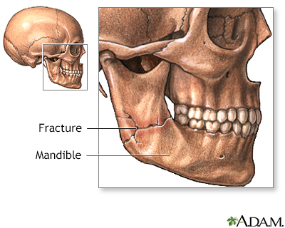 Mandibular fracture - Illustration Thumbnail
                      