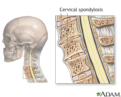 Cervical Spondylosis Information Mount Sinai New York