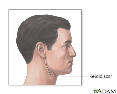 Keloid scar - Illustration Thumbnail
                      