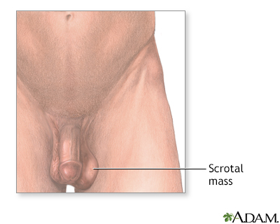 testicular lump