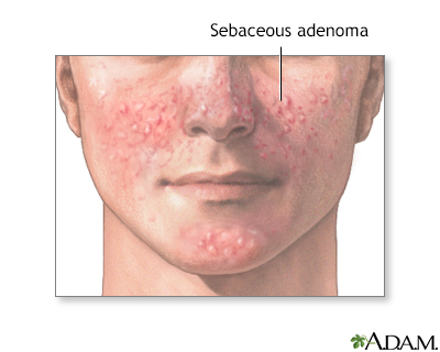 Sebaceous adenoma - Illustration Thumbnail
                      