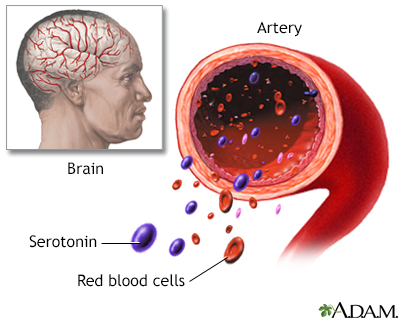 carcinoid syndrome