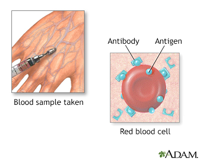 Herpes blood test - Illustration Thumbnail
              