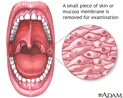 Mucosal biopsy - Illustration Thumbnail
              