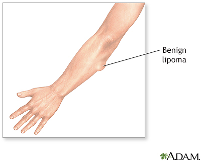 White Bumps On Inner Thigh Near Groin Female, Lipomas can form