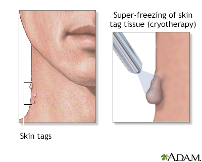 Skin Tags (Acrochordon): Causes and Treatment