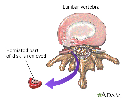 What are the Long-Term Effects of Herniated Disc in the Neck?