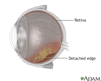 Retinal Detachment Repair Information Mount Sinai New York