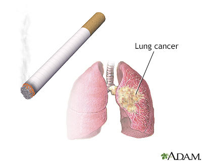 Lung cancer small cell Information Mount Sinai New York