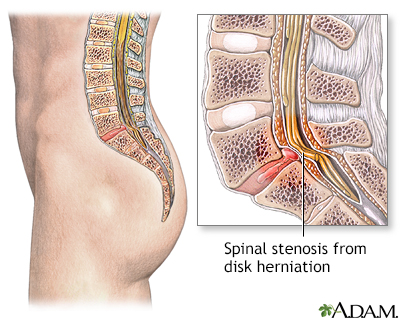 Spinal Stenosis: Lumbar