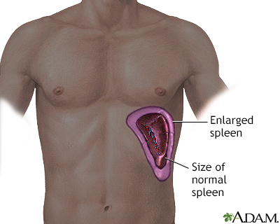 Splenomegaly Information Mount Sinai New York