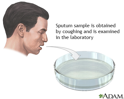 pneumonia sputum culture