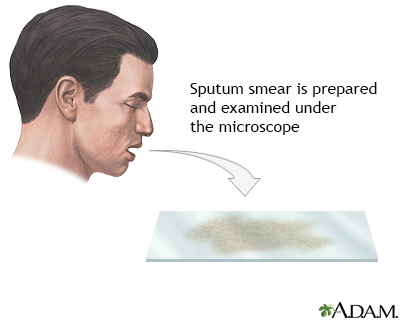 Sputum test - Illustration Thumbnail
              