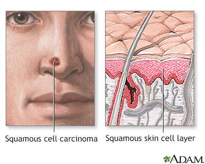 Squamous cell cancer - Illustration Thumbnail              