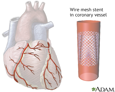 stent heart placement angioplasty surgery bypass coronary artery arteries peripheral invasive discharge cardiac minimally definition references adam