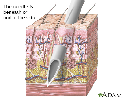 Skin layers and needles - Illustration Thumbnail
              