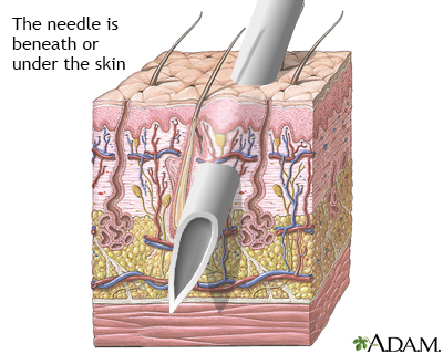 Skin layers and needles - Illustration Thumbnail
                      