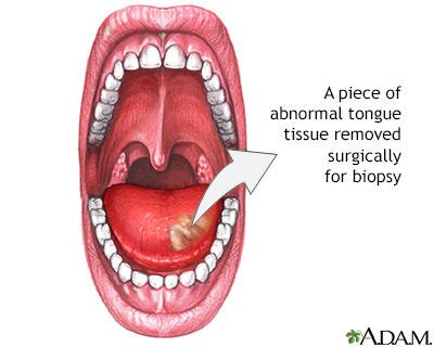 Tongue biopsy - Illustration Thumbnail
              