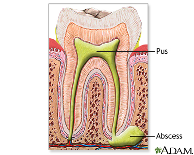 infected tooth