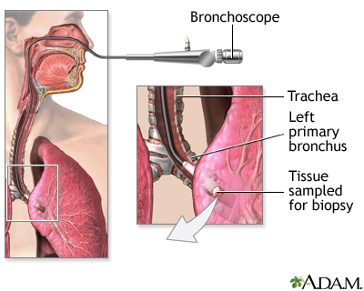 Bronchoscope