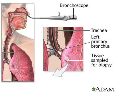 Lung Cancer Small Cell Information Mount Sinai New York