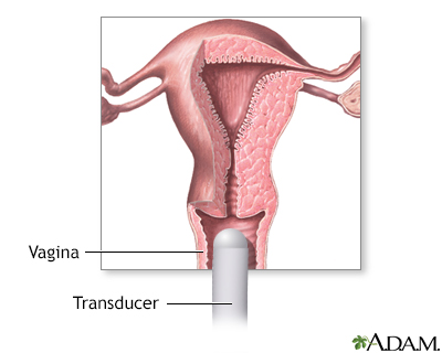 Transvaginal ultrasound - Illustration Thumbnail
              