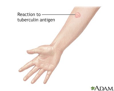 Tuberculin skin test