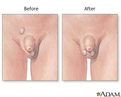 Before and after testicular repair - Illustration Thumbnail
              