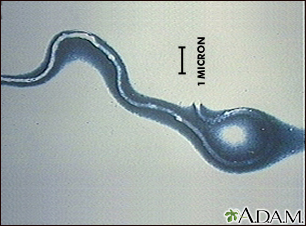 Enfermedad de Lyme - organismo Borrelia burgdorferi - Miniatura de ilustración
              