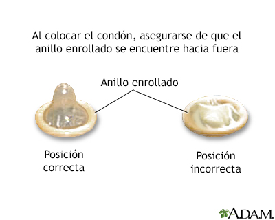 Colocación del condón - serie - Miniatura de presentación
              