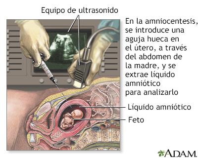 Amniocentesis - Miniatura de ilustración
              