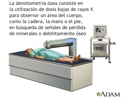 Densitometría ósea - Miniatura de ilustración
              