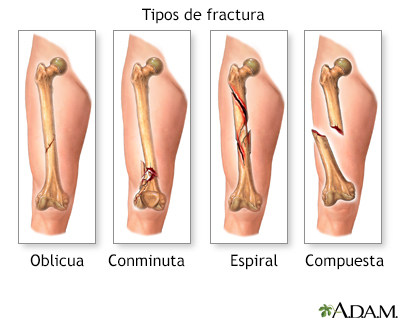 Tipos de fractura (1) - Miniatura de ilustración
              