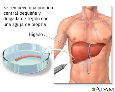 Biopsia de hígado - Miniatura de ilustración
              