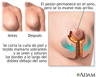 Mamoplastia - Miniatura de ilustración
              